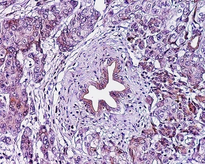 Cancer pancreas tne