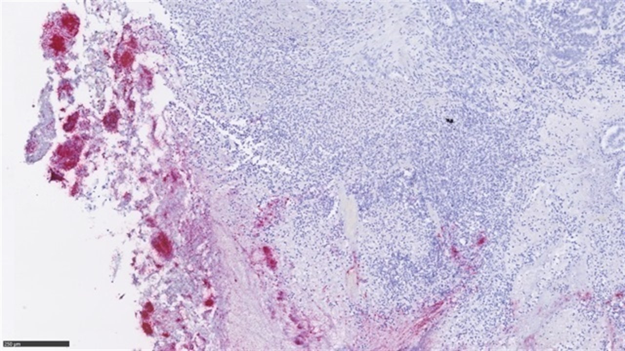 Microbiota metstasis 