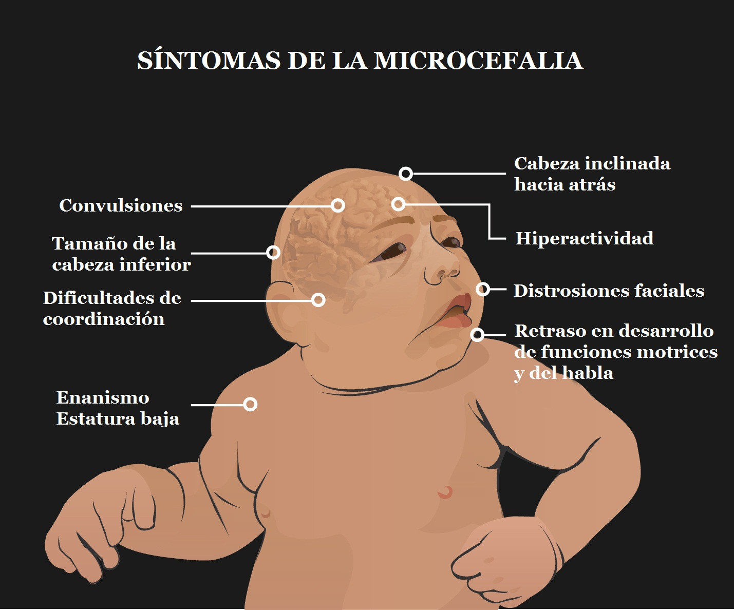 Microcefalia sintomascopia