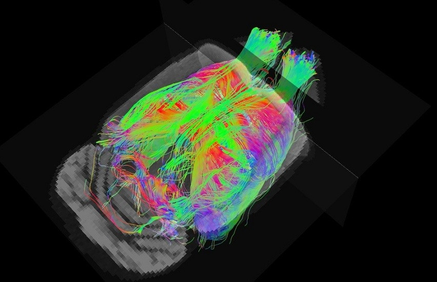 Alzheimer resonancia magnética 10042018