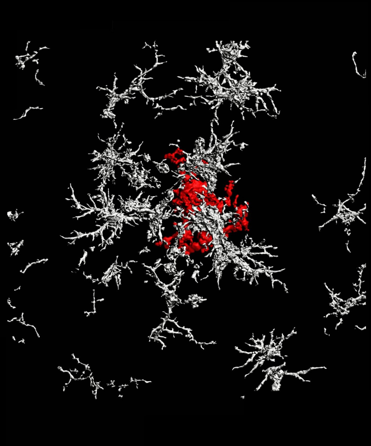 Archivo - Una placa de beta amiloide de núcleo denso (rojo) rodeada de microglía que carece de receptores TAM (blanco) en el cerebro de un ratón con enfermedad de Alzheimer.