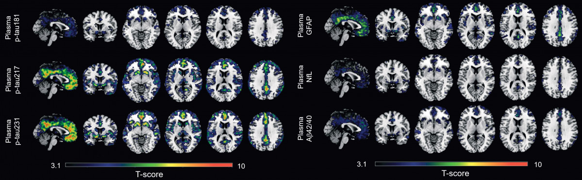 Un estudio identifica dos biomarcadores en sangre para captar los primeros indicios del Alzheimer