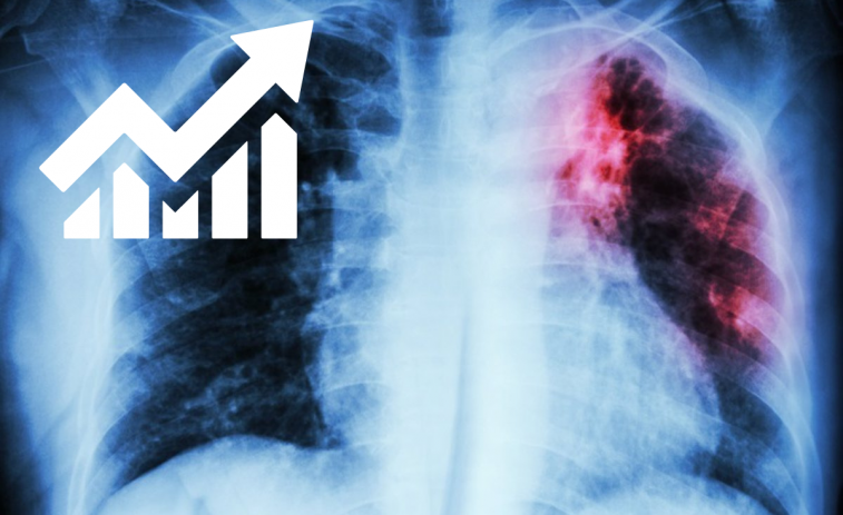 Detectan un aumento de casos de cáncer de pulmón en mujeres y jóvenes