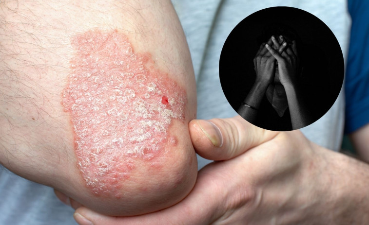 ¿Por qué la psoriasis se asocia a la depresión?