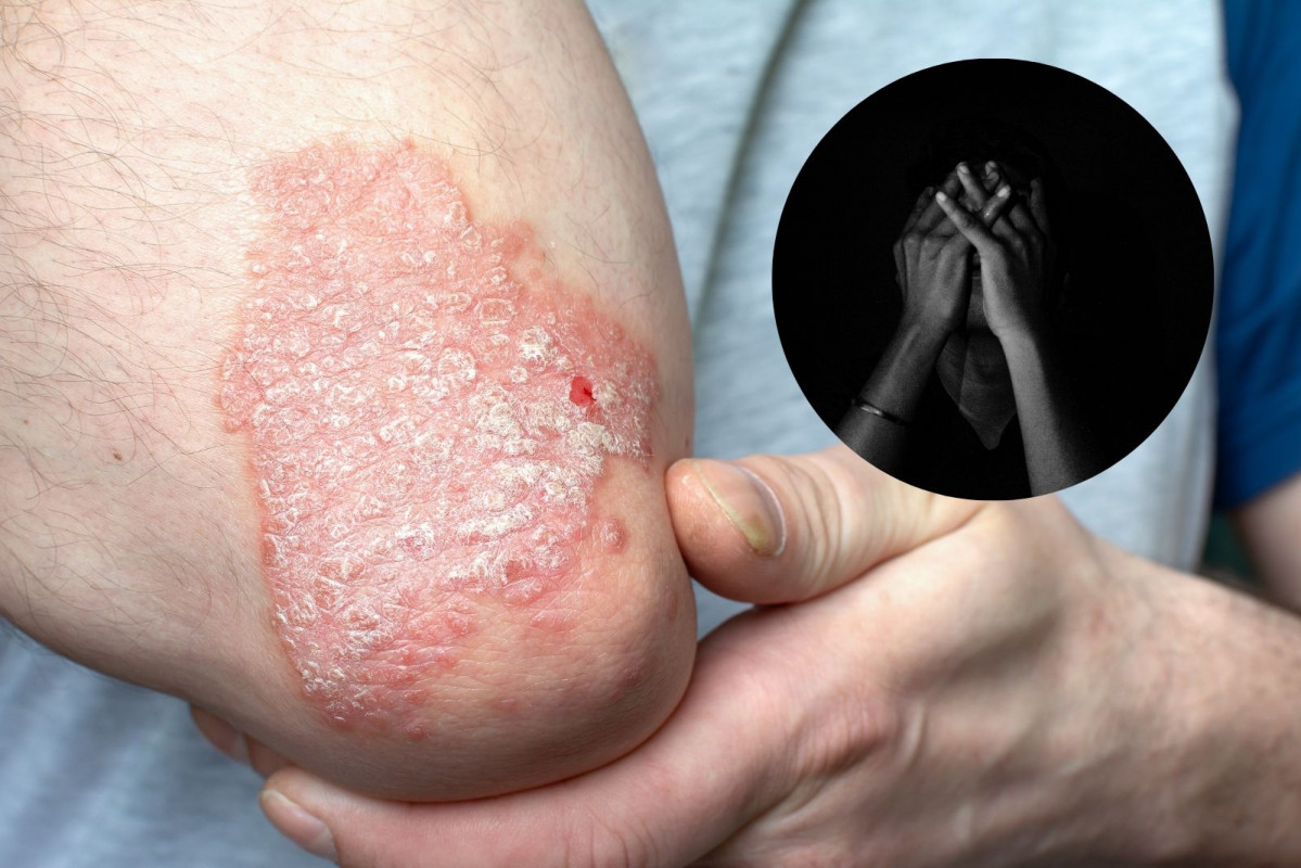 Psoriasis