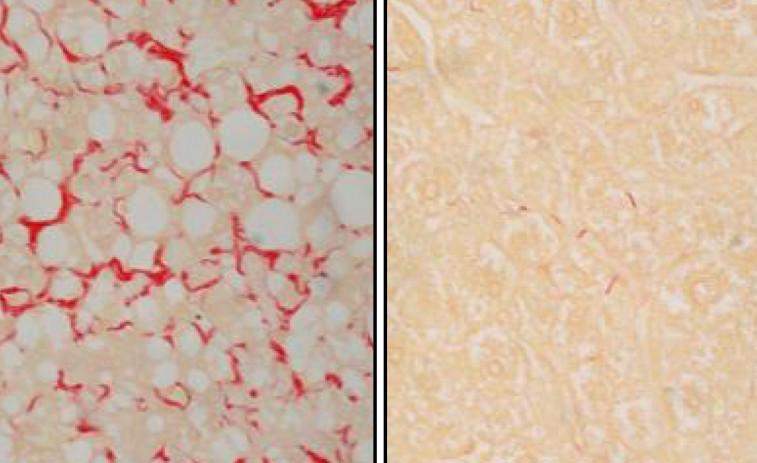 Curan en ratones la enfermedad hepática MASH, vinculada a la obesidad y la diabetes