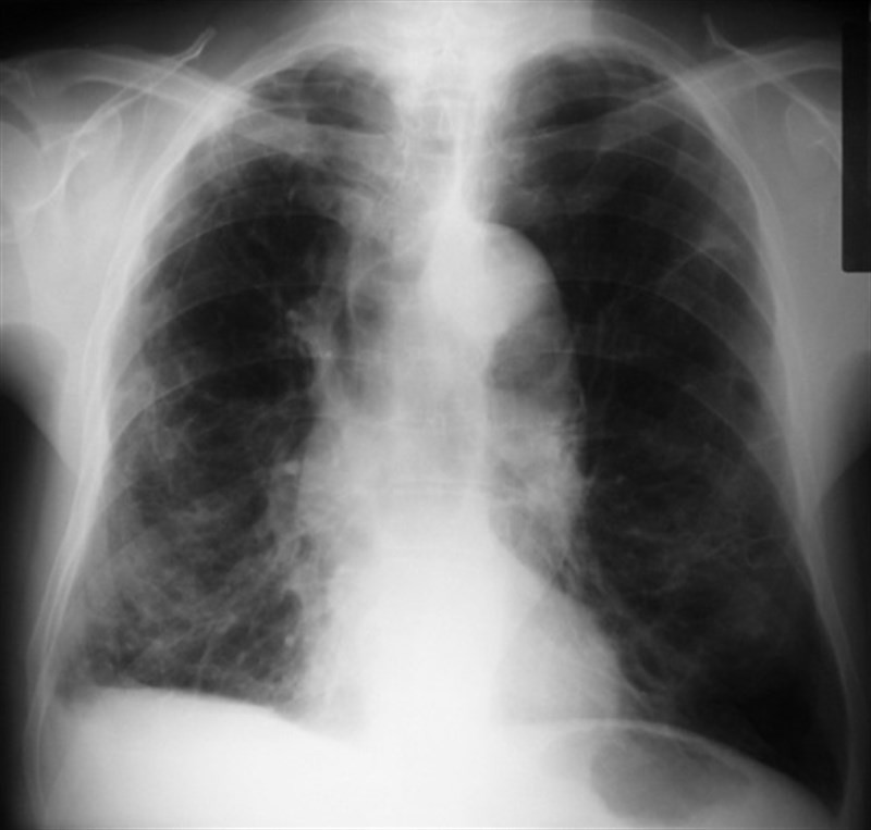 Pulmones